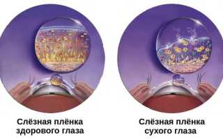 Синдром сухого глаза что такое