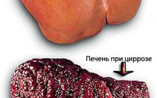Портальный цирроз печени код мкб