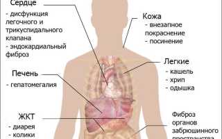 Как жить с карциноидным синдромом