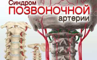 Как лечит синдром позвоночных артерий