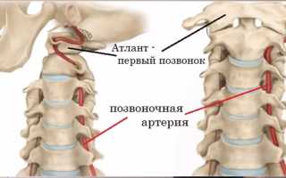 Вертеброгенные синдромы при шейном остеохондрозе