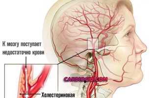 Синдромы при дэп 2 стадии