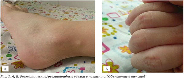 Диагностика суставного синдрома у детей