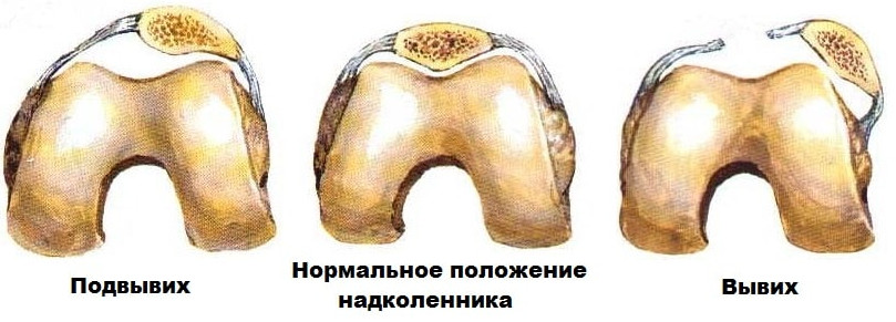 Код мкб вывих коленного сустава