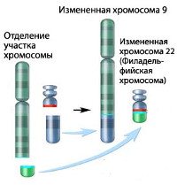 Хронический миелолейкоз