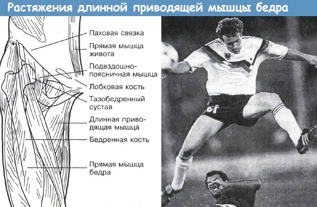 Растяжение мышц