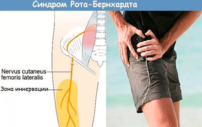 синдром Рота Бернгардта