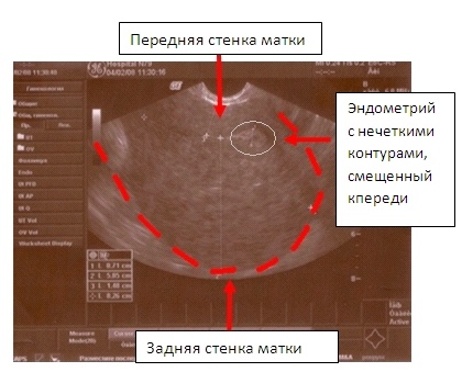 Внутренний эндометриоз (аденомиоз) на УЗИ