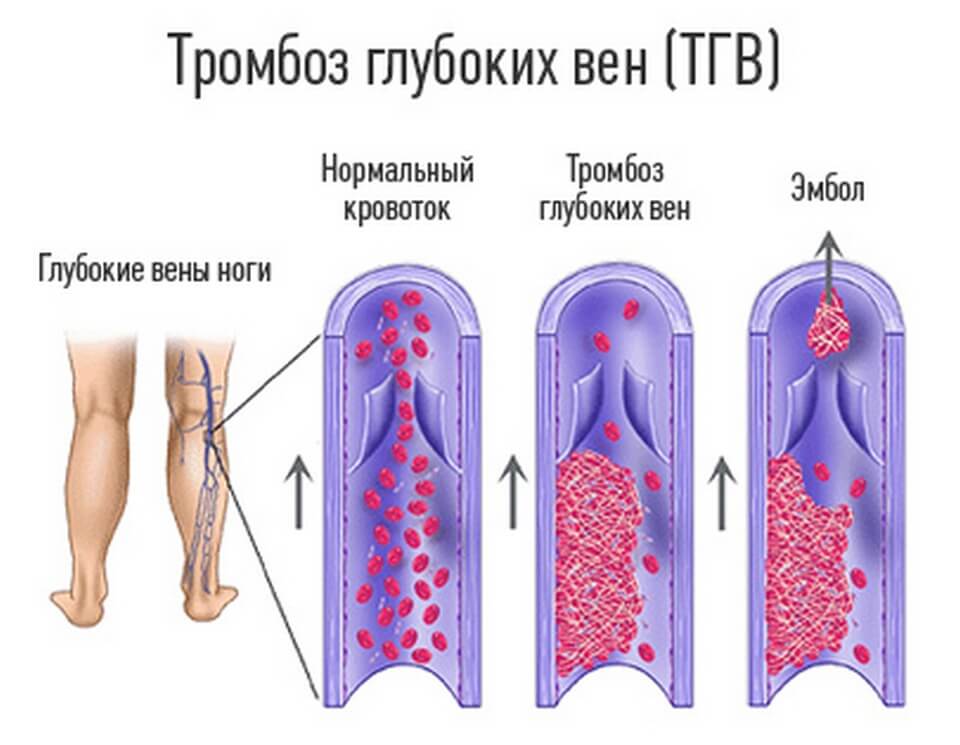 Тромбоз вен нижних конечностей