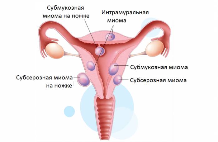 Диагноз миома матки с геморрагическим синдромом