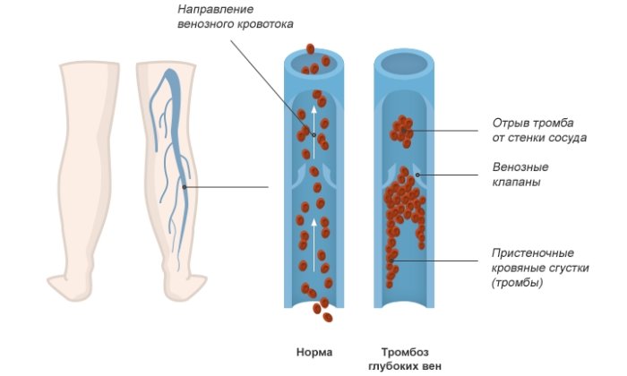 Причины образования тромба