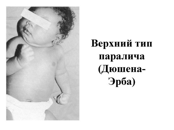 парез эрба дюшена