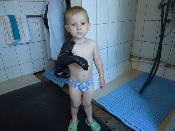рука в гипсе