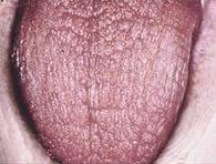 Симптомы синдрома Шегрена Симптомы синдрома Шегрена