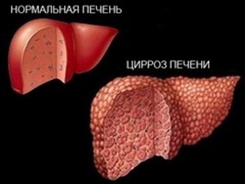 Цирроз