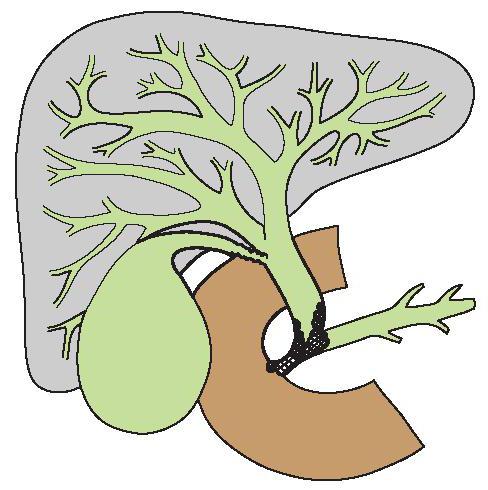 опухоль Клацкина