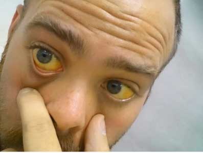 Желтушность глаз