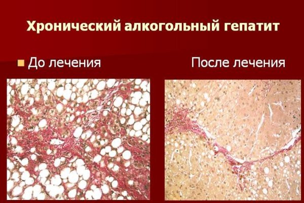 Хронический алкогольный гепатит