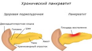 хронический панкреатит