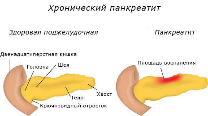 хронический панкреатит