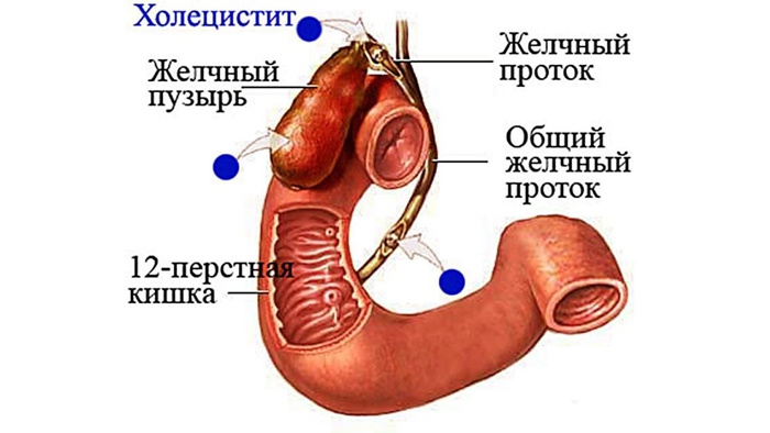 холецистит