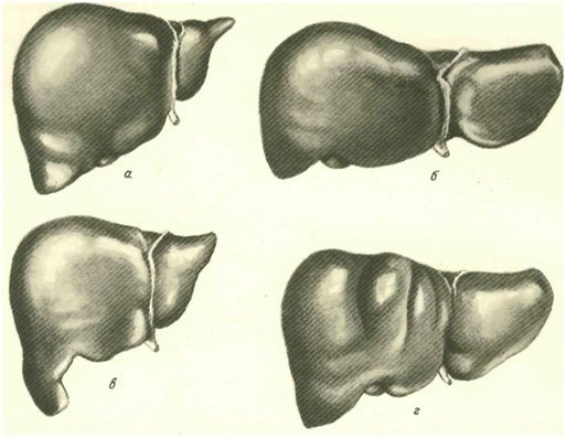 аномалии в строении печени