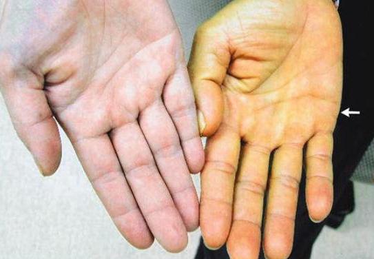 желтизна кожных покровов