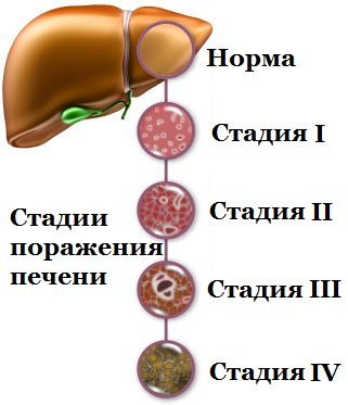 стадии цирроза
