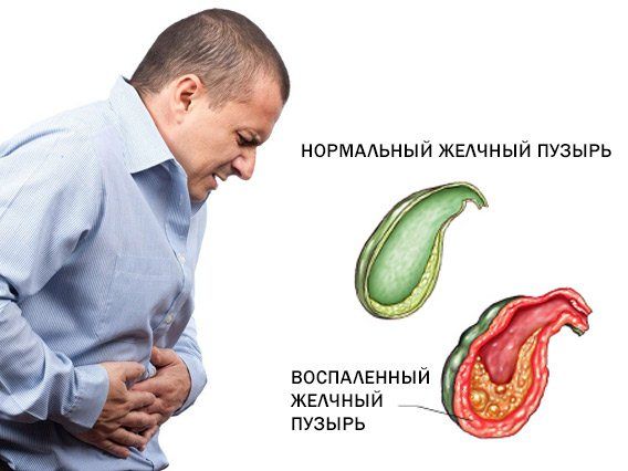 холецистит
