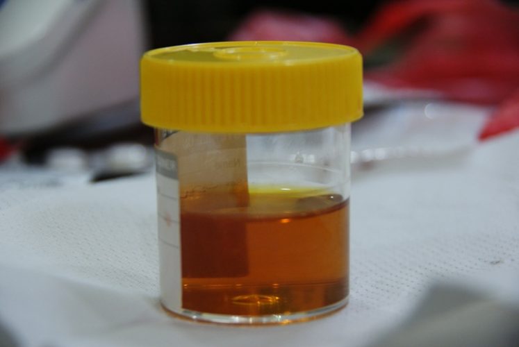 Цвет мочи при желтухе