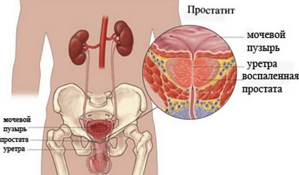 Prostatit