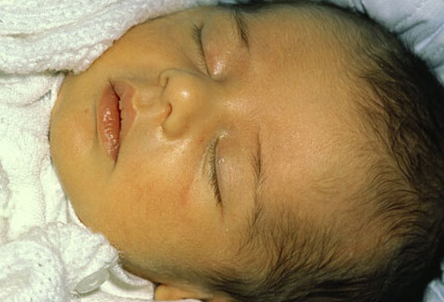 физиологическая желтуха новорожденных