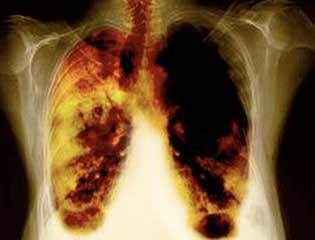 Что бывает, когда человек бросил курить: последствия для организма