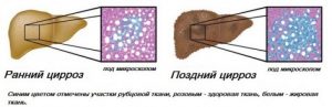стадии цирроза