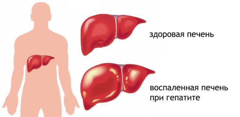 Токсический гепатит
