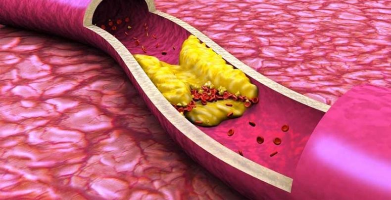 холестериновая бляшка