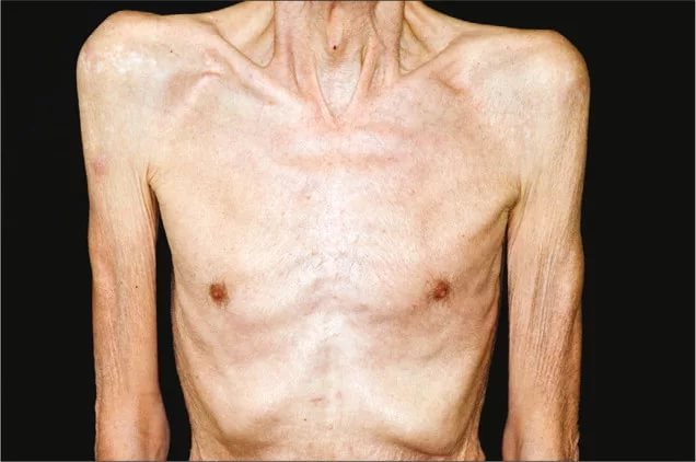 сильное похудение при гепатите