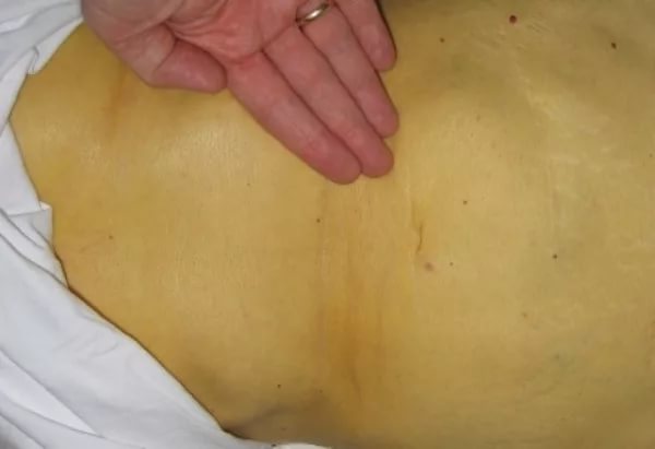 Гемолитическая желтуха