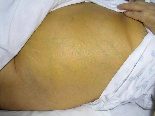 Так проявляется желтуха