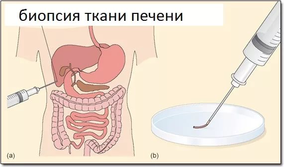 Биопсия печени