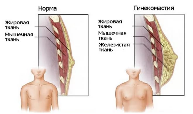 увеличение молочных желёз у мужчин