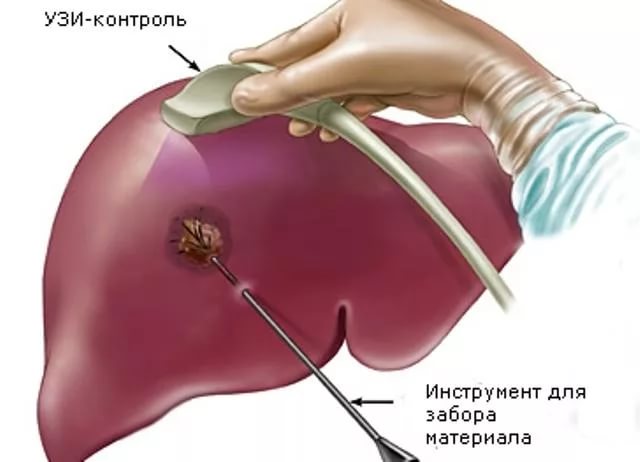 Биопсия при циррозе печени