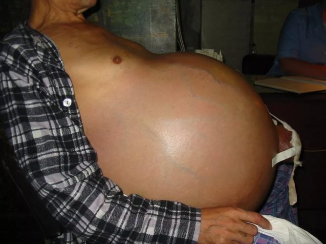 Сколько живут с циррозом печени 4 степени