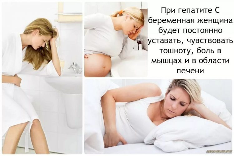 Симптомы у беременных при гепатите
