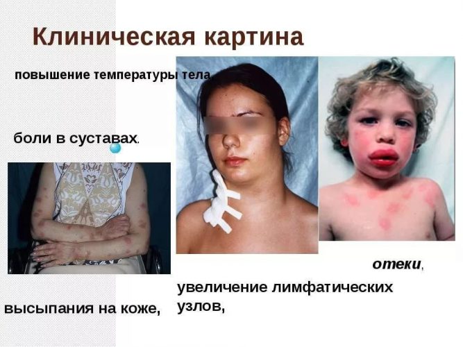 Симптомы алкогольного гепатита