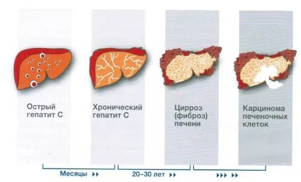 гепатит С