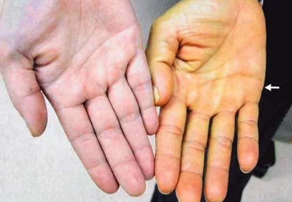 Желтушность кожи