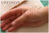 Иглоукалывание от курения Иглоукалывание от курения