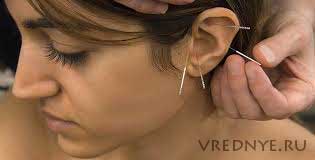 Иглоукалывание от курения Иглоукалывание от курения