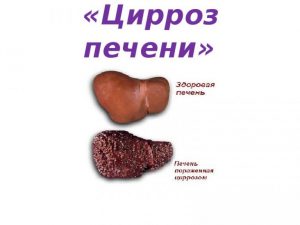 цирроз печени
